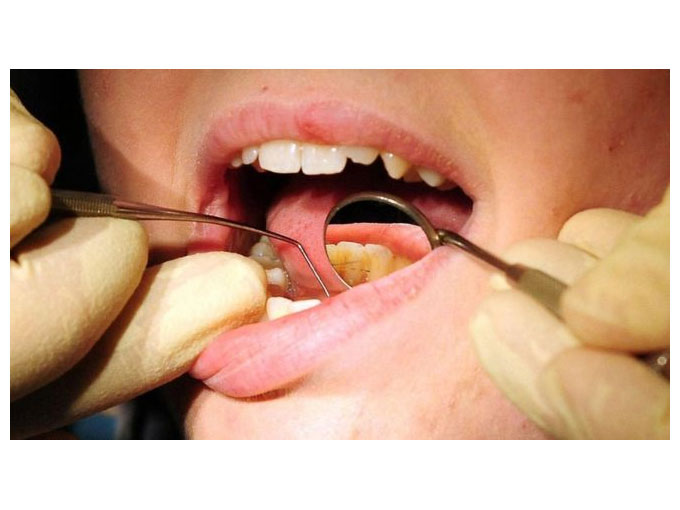 Dişeti hastalarının bunama ihtimali yüzde 70 daha fazla